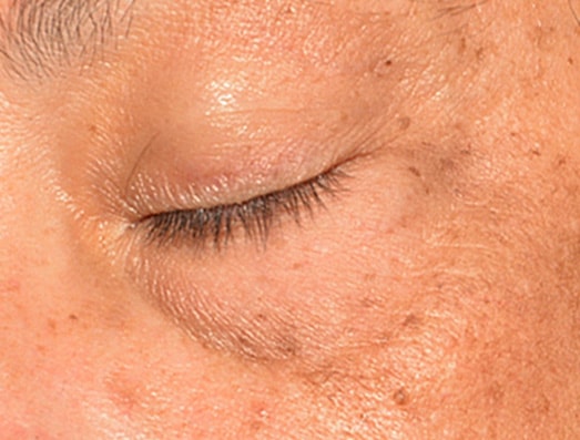 Eyecon Øyebehandling