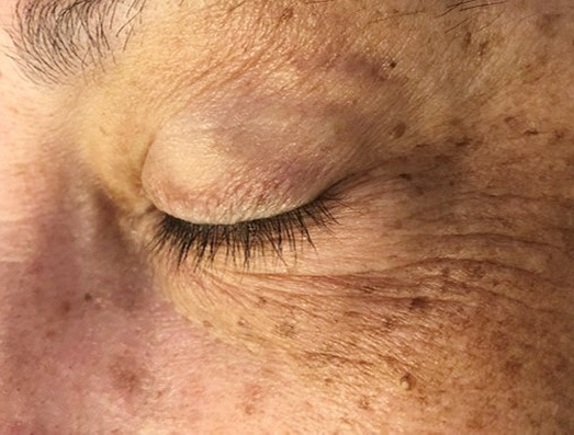 Eyecon Øyebehandling