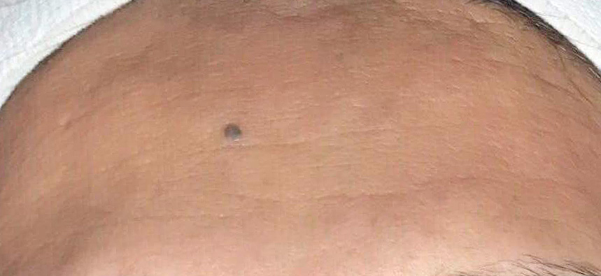 Dermatude behandling, etter