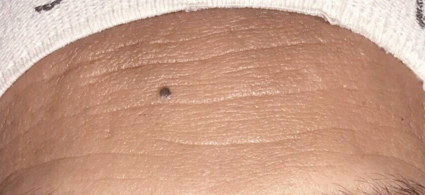 Dermatude behandling, før