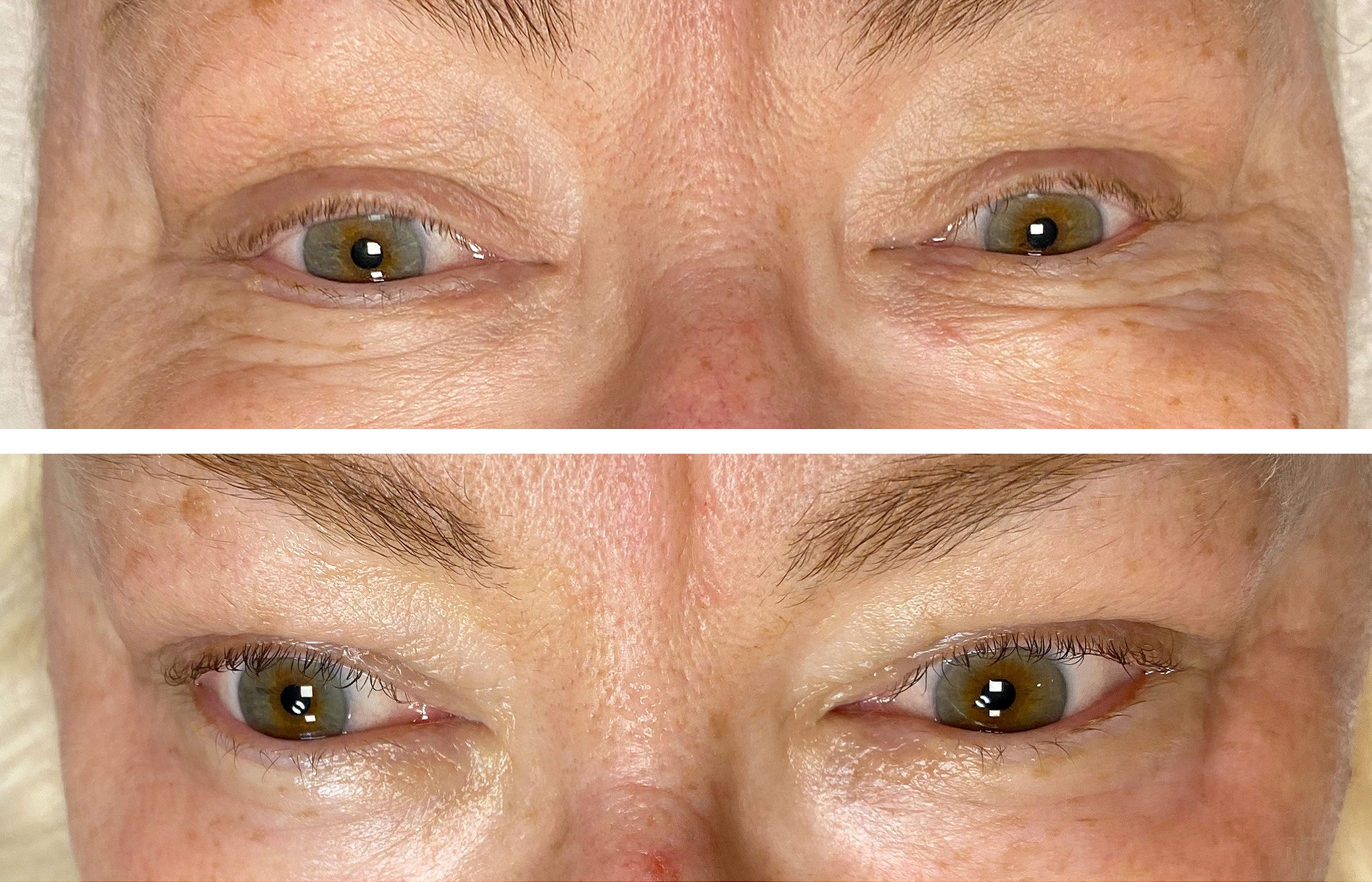 Eyecon øyebehandling, før og etter