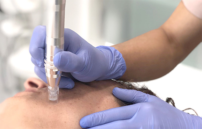 microneedling microneedling